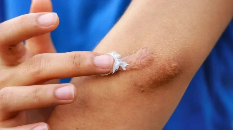 Cara Menghilangkan Bekas Luka Secara Alami