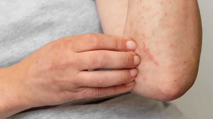 Ini Cara Merawat Kulit agar Tak Alami Dermatitis Atopik