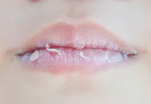 Tips Mengatasi Bibir Kering saat Puasa