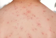 Penyebab Cacar Air dan Faktor Risikonya