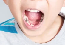 Penyebab Gigi Keropos dan Cara Merawatnya agar Tetap Sehat.