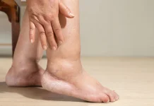Jangan Abaikan Kaki Bengkak, Bisa Jadi Sinyal Ginjal