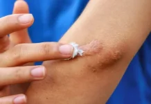 Cara Menghilangkan Bekas Luka Secara Alami
