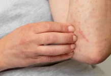 Ini Cara Merawat Kulit agar Tak Alami Dermatitis Atopik