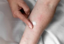 Kenali Dermatitis Atopik dan Cara Mencegah Kekambuhannya