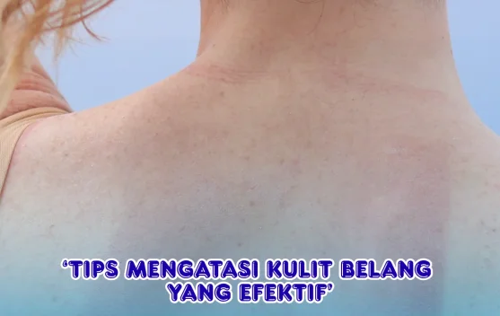 Tips Mengatasi Kulit Belang yang Efektif - RRI.co.id
