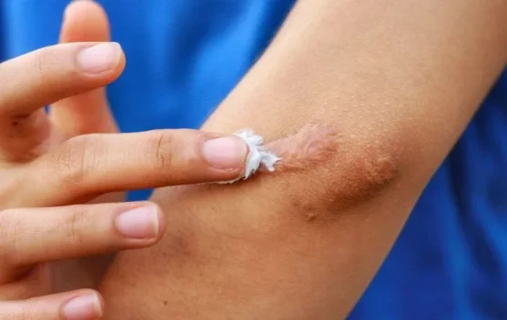 Cara Menghilangkan Bekas Luka Secara Alami