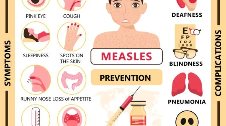 5 Komplikasi Campak yang Harus Diperhatikan