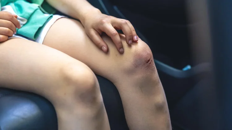 Gatal pada Luka Sembuh ternyata Bagian Proses Pemulihan Tubuh