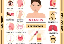5 Komplikasi Campak yang Harus Diperhatikan