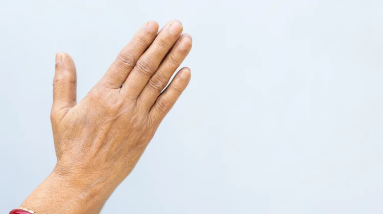 Tangan Tampak Tua usai Diet? Hati-Hati 'Ozempic Hands'!