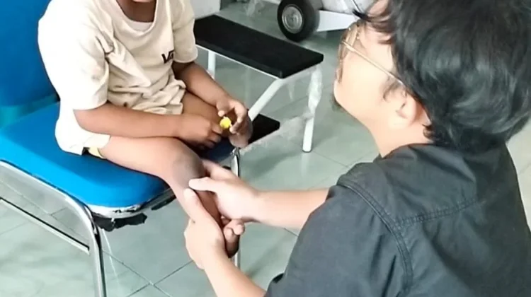 Kolaborasi Kemanusiaan Bantu Irsya Wujudkan Impian Gunakan Kaki Palsu