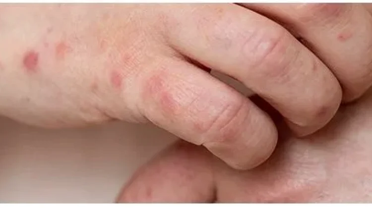 Waspada Lupus, Penyakit Seribu Wajah