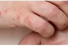 Waspada Lupus, Penyakit Seribu Wajah