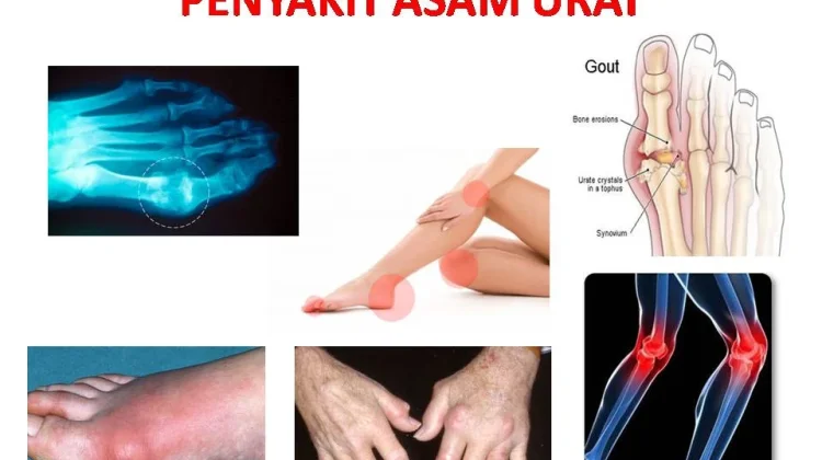 Makanan Penurun Asam Urat Paling Ampuh, Nomor 1 Bikin Kaget