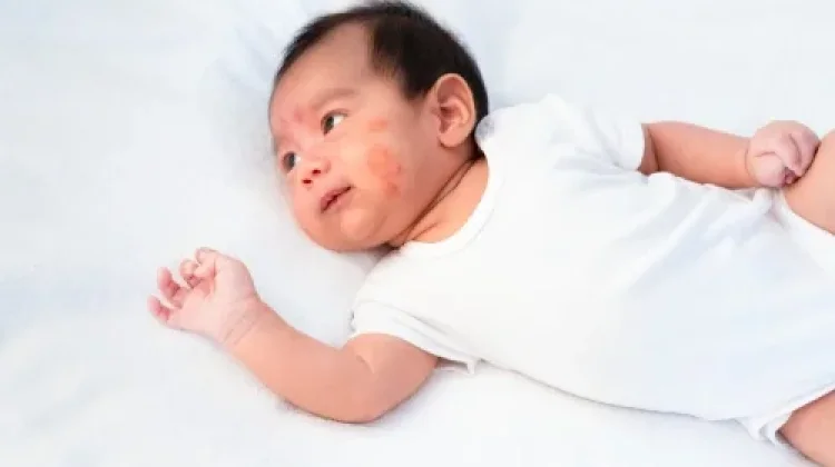 Cara Mengatasi Alergi Susu Sapi pada Anak