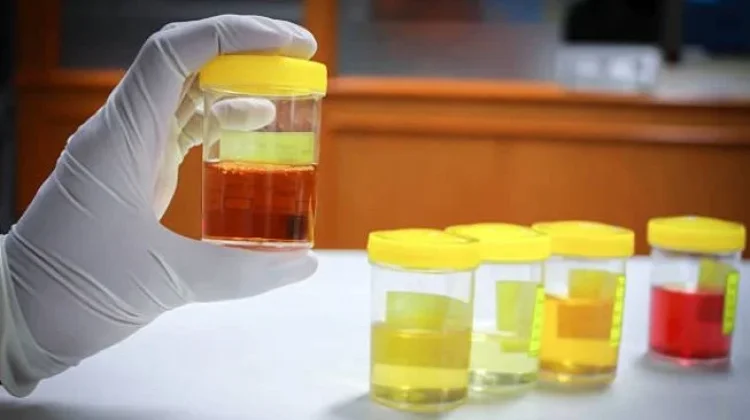 Ciri Urine yang Menjadi Tanda Gangguan Ginjal