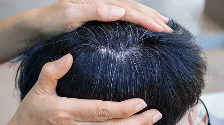Penyebab Rambut Berubat diusia Muda