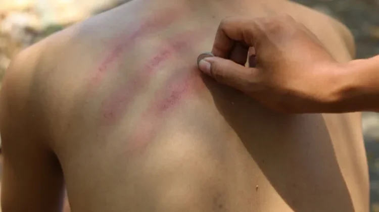 Manfaat Kerokan dalam Mengatasi Masuk Angin