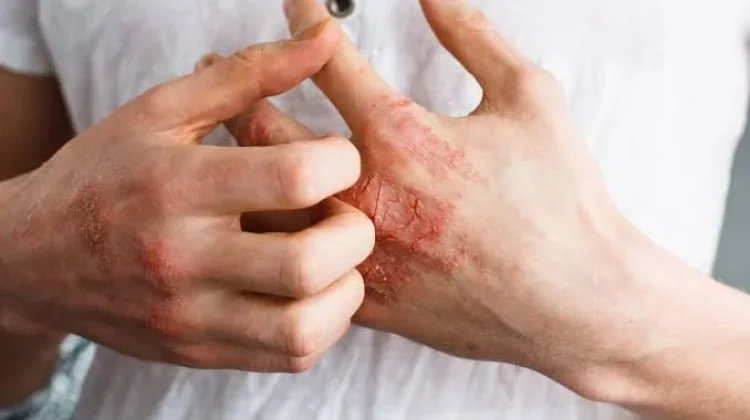 Hipersensitivitas, Ini yang Perlu Diketahui