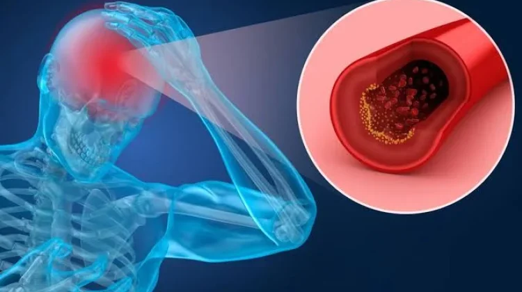 Penumpukan Plak di Pembuluh Darah Dipicu Gaya Hidup Tidak Sehat