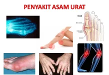 Makanan Penurun Asam Urat Paling Ampuh, Nomor 1 Bikin Kaget