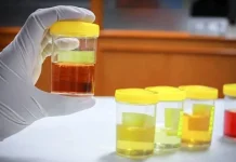 Ciri Urine yang Menjadi Tanda Gangguan Ginjal