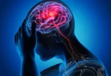 5 Gejala Ringan Ini menjadi Tanda Stroke yang Harus Diwaspadai