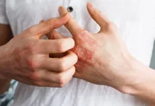 Hipersensitivitas, Ini yang Perlu Diketahui