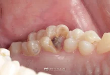 Sakit Gigi dan Cara Mengatasinya