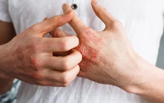 Hipersensitivitas, Ini yang Perlu Diketahui