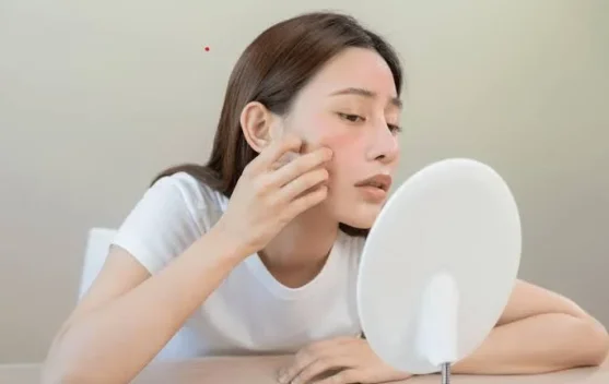 Jerawat Sering Muncul? Ini Cara Memperbaiki Skin Barrier agar Kulit Lebih Sehat