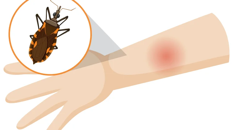Penyakit Chagas, Infeksi Tropis yang Perlu Diwaspadai