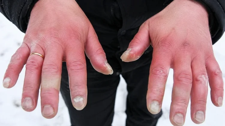 Frostbite Ancam Jaringan Tubuh saat Cuaca Ekstrem Dingin