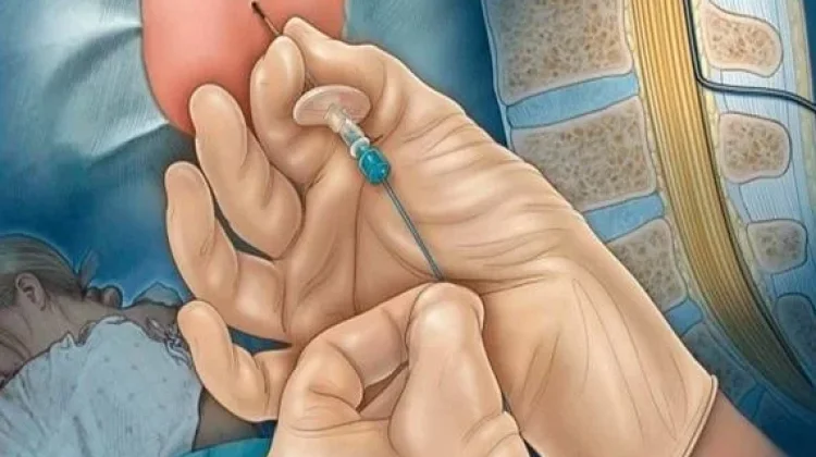 Bius Epidural: Pengertian, Manfaat, Prosedur, dan Risikonya