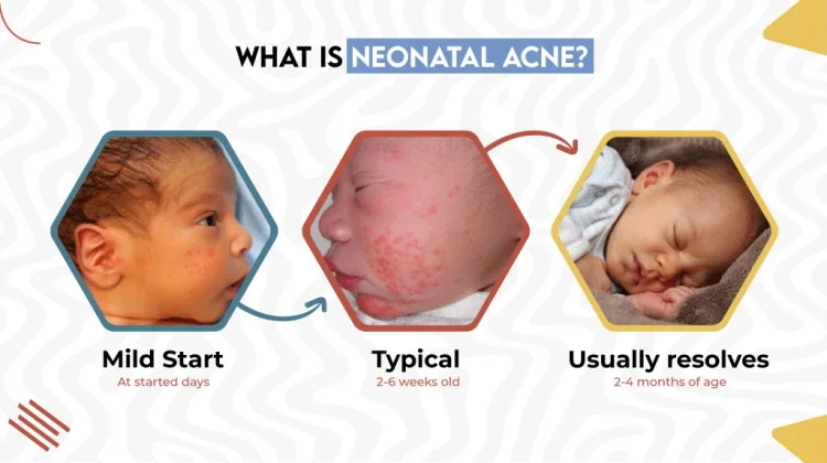 Kenali Neonatal Acne, Jerawat yang Bisa Muncul pada Bayi