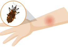 Penyakit Chagas, Infeksi Tropis yang Perlu Diwaspadai