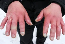 Frostbite Ancam Jaringan Tubuh saat Cuaca Ekstrem Dingin