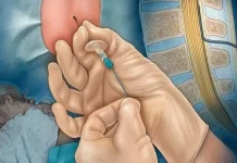Bius Epidural: Pengertian, Manfaat, Prosedur, dan Risikonya