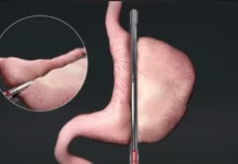 Bedah Bariatrik, Solusi Medis Penderita Obesitas yang Sulit Turunkan Berat Badan