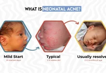 Kenali Neonatal Acne, Jerawat yang Bisa Muncul pada Bayi