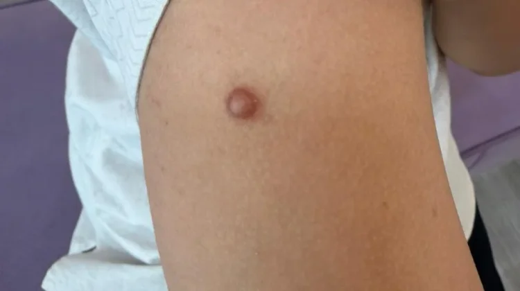 Kenapa Keloid Muncul setelah Cacar?
