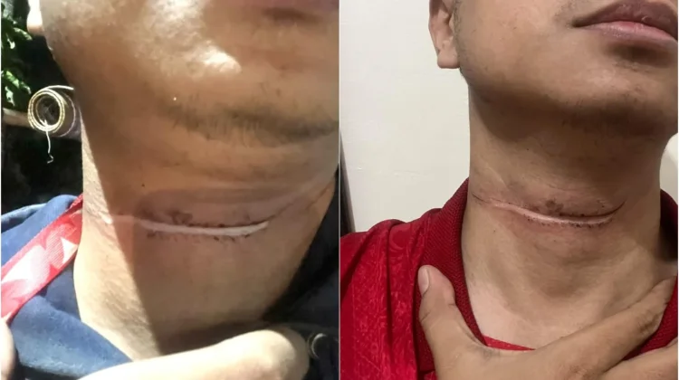 Warga Sragen Kembali Jadi Korban Kabel Internet Semrawut, Leher Luka Terjerat