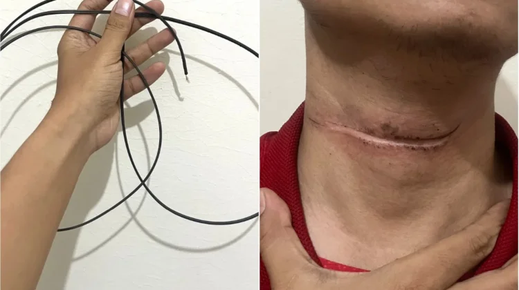Cerita Warga Sumberlawang Sragen Nyaris Tewas, Leher Tersayat Kabel Internet