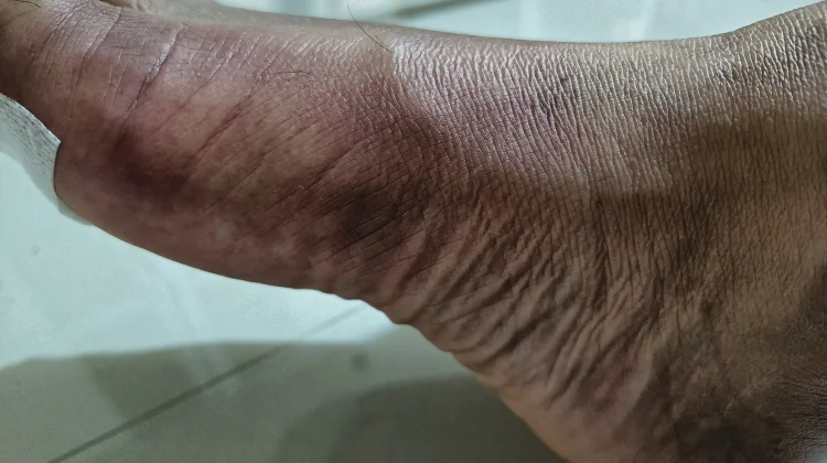 Kenali Empat Jenis Patah Tulang