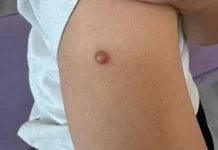 Kenapa Keloid Muncul setelah Cacar?