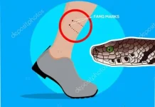 Pertolongan Pertama Gigitan Ular Harus Tepat, Tekankan Imobilisasi