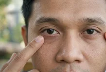Alasan Ilmiah Penyebab Mata Berkedut