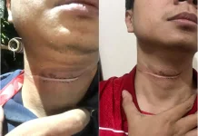Warga Sragen Kembali Jadi Korban Kabel Internet Semrawut, Leher Luka Terjerat