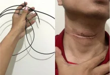 Cerita Warga Sumberlawang Sragen Nyaris Tewas, Leher Tersayat Kabel Internet